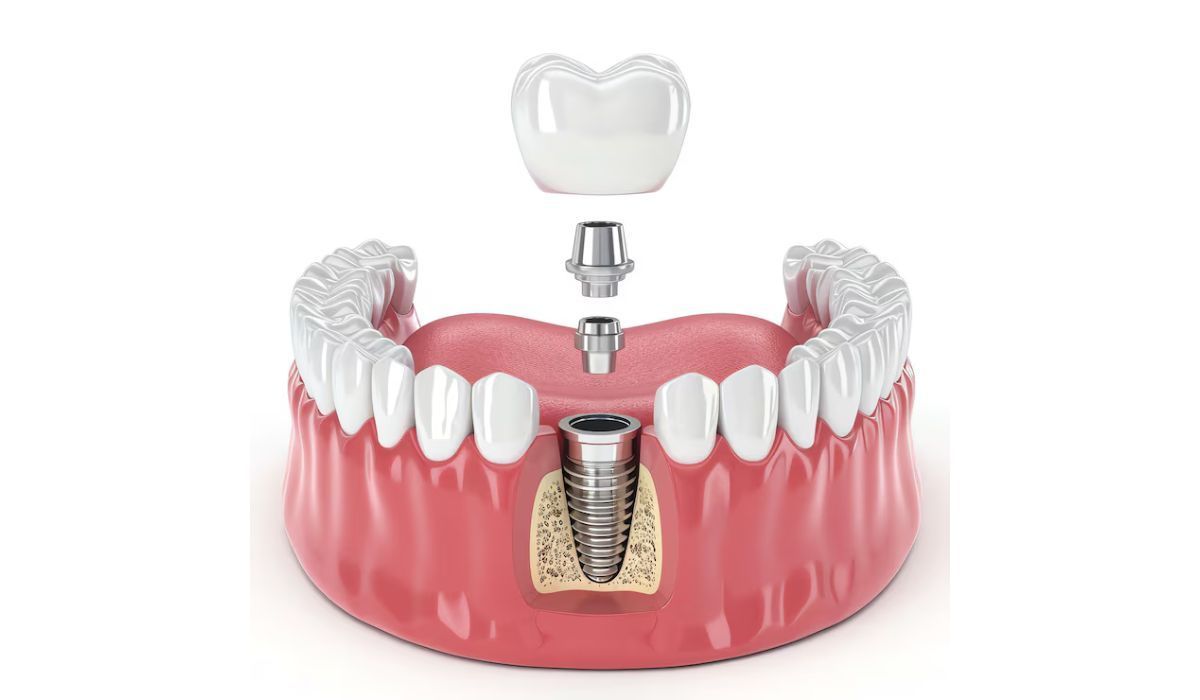 Benefits of Choosing a Dental Implant in Burbank CA Over Dentures