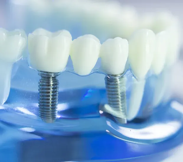 Dentist Insurance Plans and Cosmetic Dental Services Simi Valley Achieving a Beautiful Smile Without Fiscal Stress