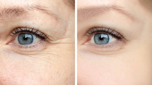 What Do People Really Want To Know About Botox San Jose Before Getting It Done?